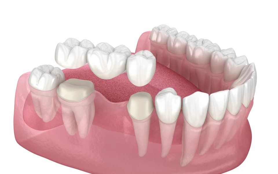 Dental bridge restoration procedure at Bristol Dental Clinic