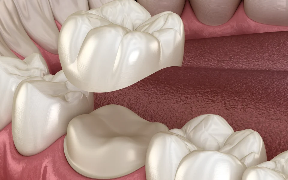 Dental crown restoration procedure at Bristol Dental Clinic